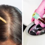 Combine PRF and medications for better hair regrowth results