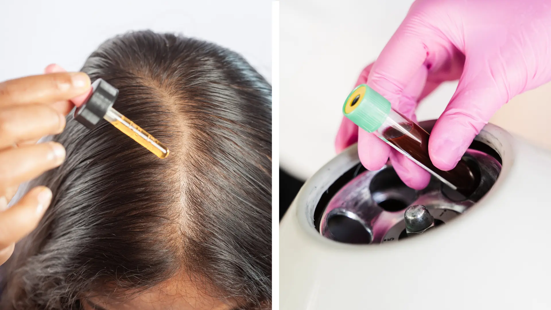 Combine PRF and medications for better hair regrowth results