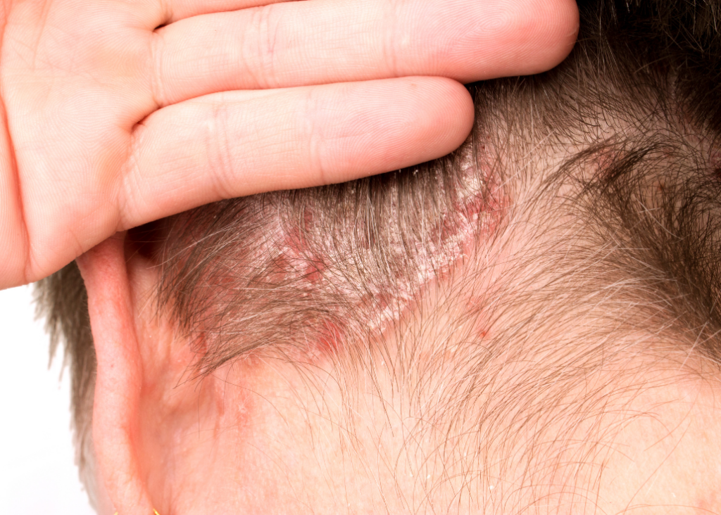 Psoriasis Scalp Treatment