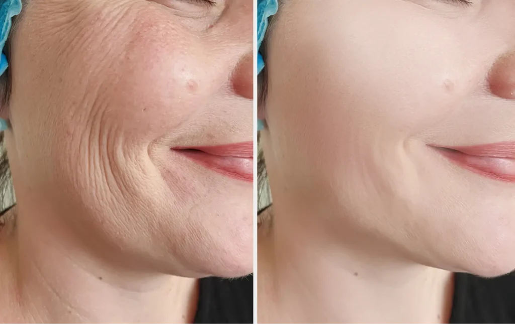 Anti-Wrinkle Injections