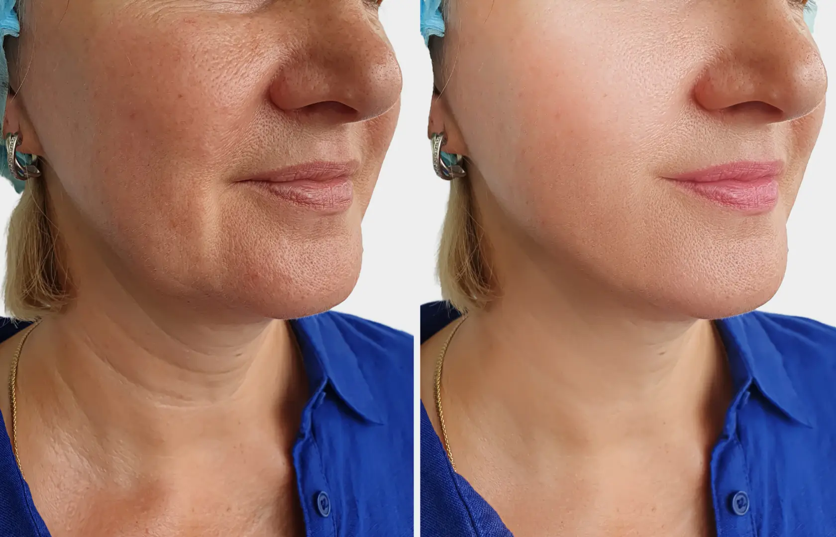 Bio Remodelling Treatment