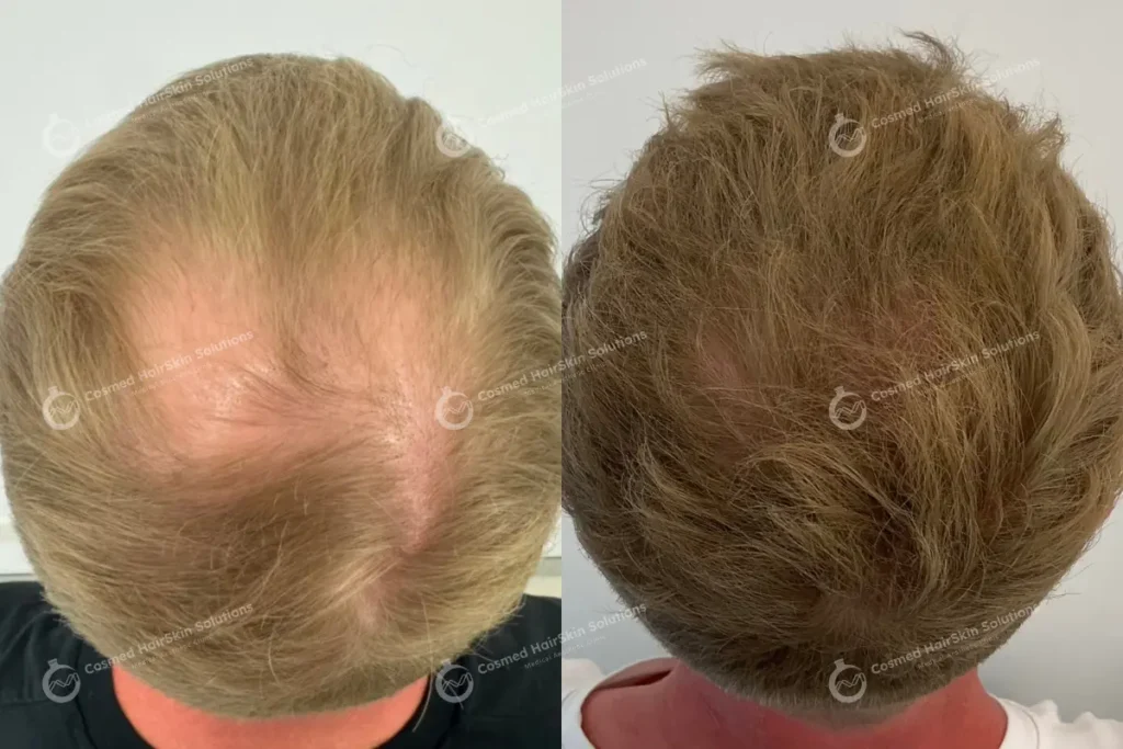 Results after treatment at Cosmed