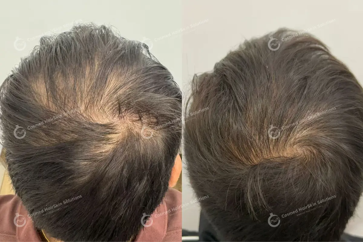 Results after treatment at Cosmed