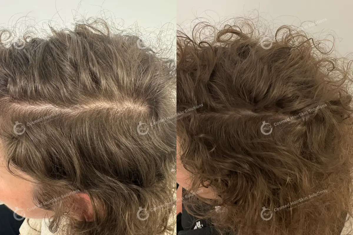 Results after treatment at Cosmed