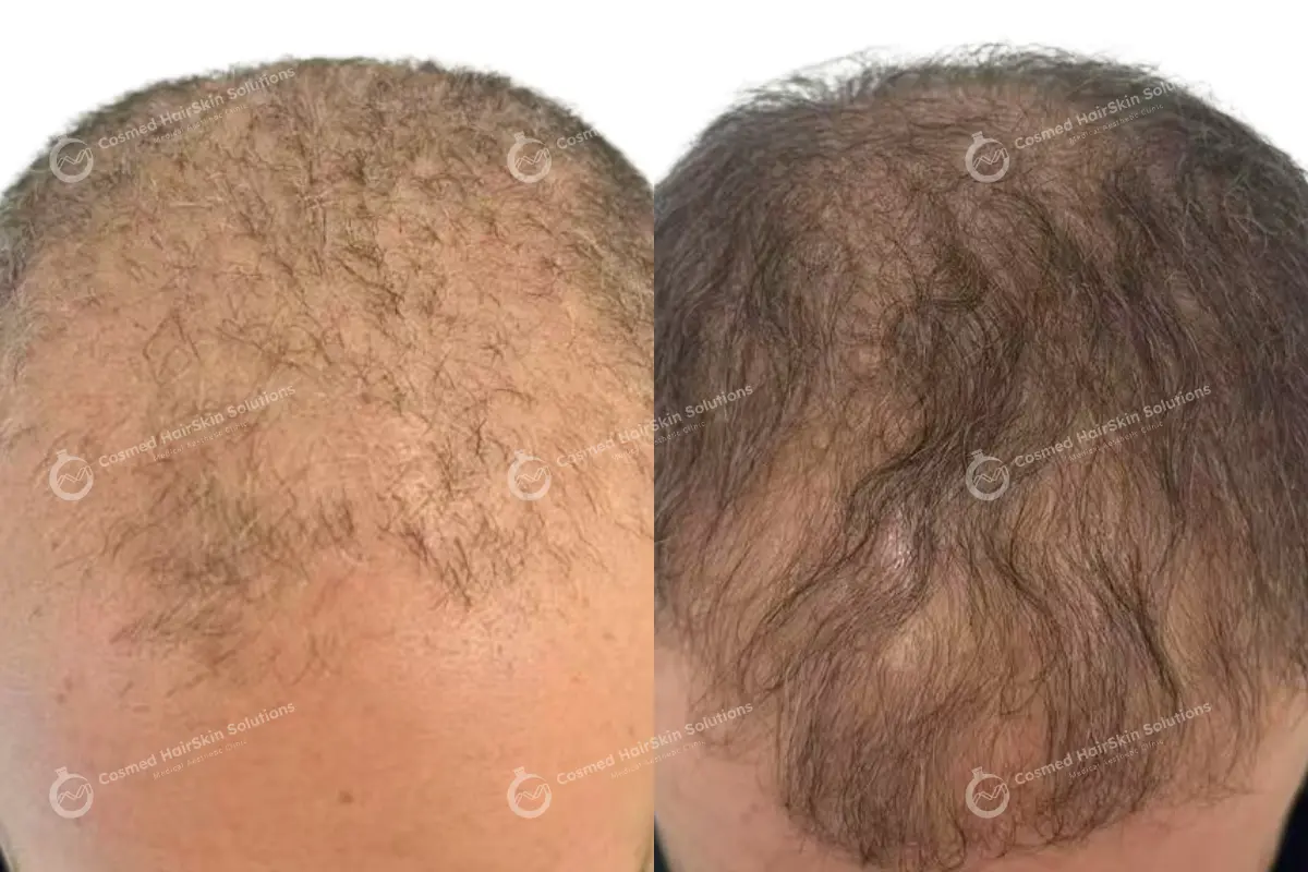 Results after treatment at Cosmed
