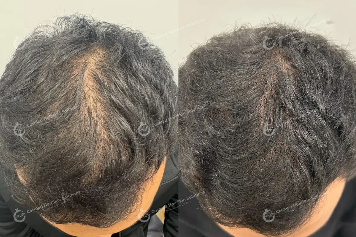 Results after treatment at Cosmed