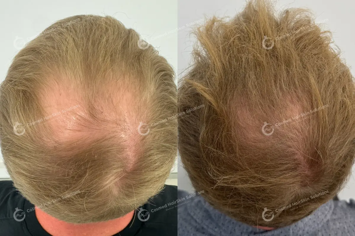 Results after treatment at Cosmed