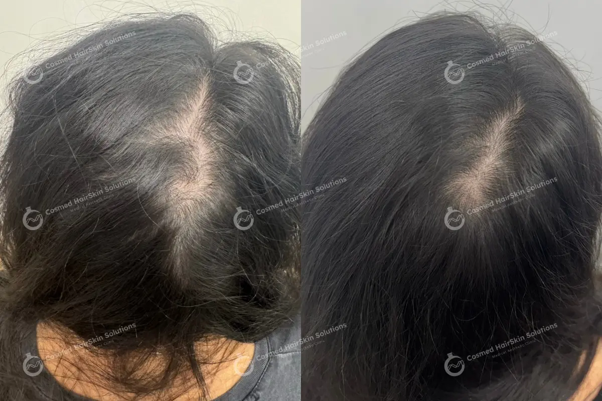 Results after treatment at Cosmed