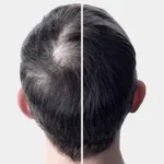 PRF Scalp Treatment at Cosmed