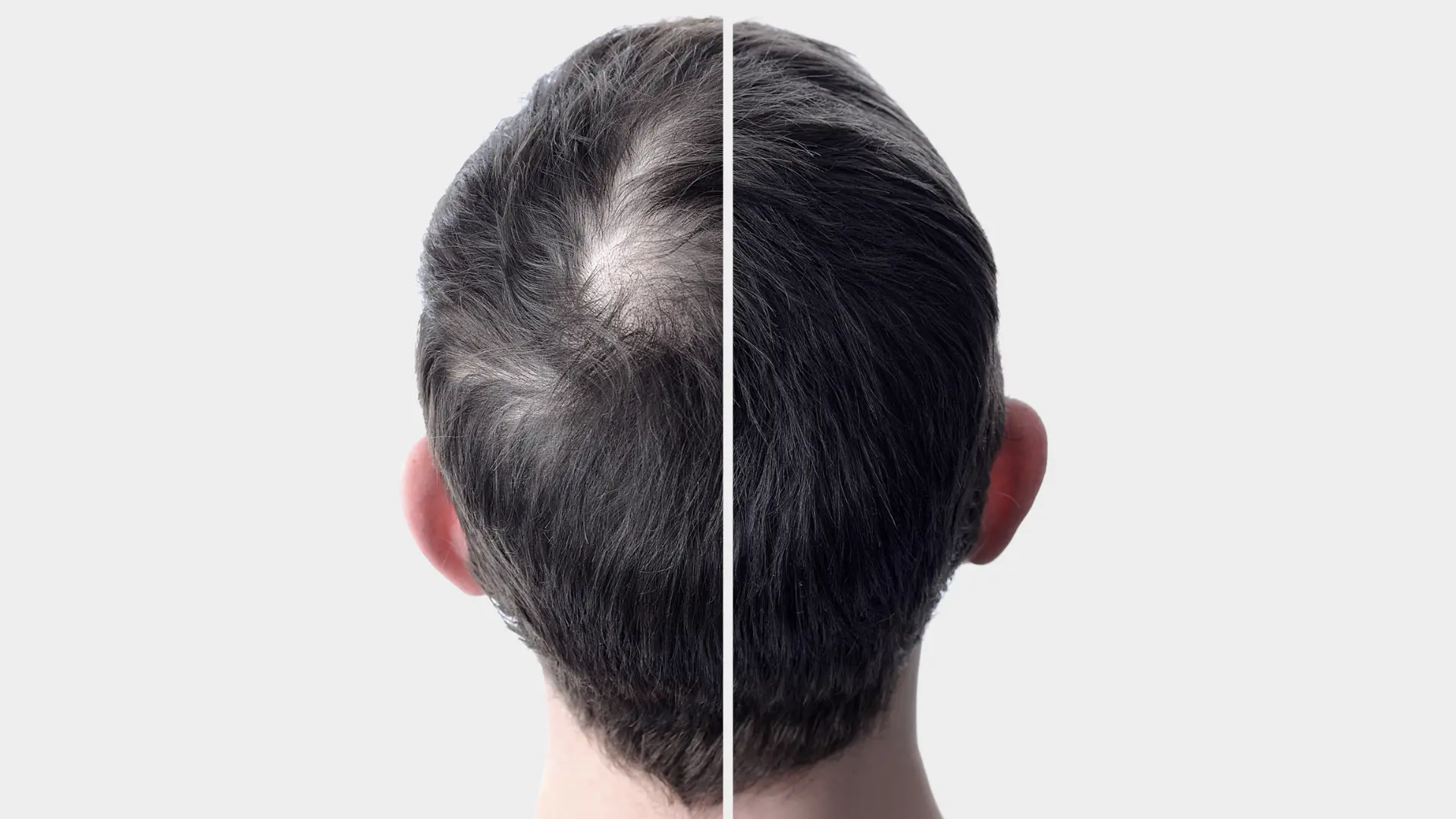 hair loss treatments