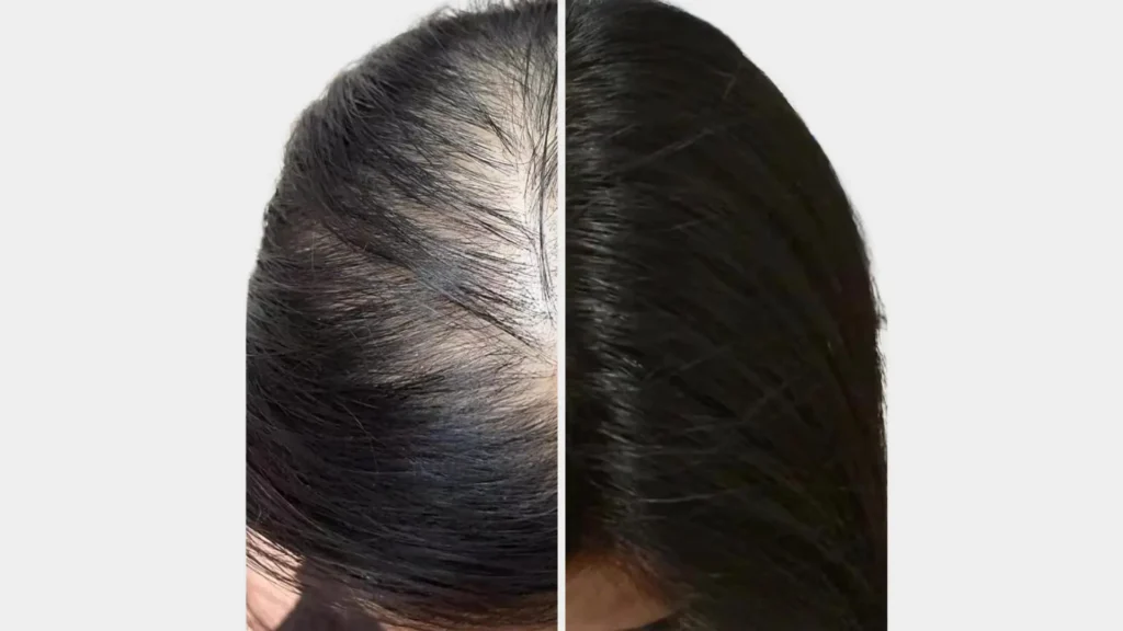 PRP Hair Loss Treatment