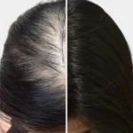 PRP Scalp Treatment at Cosmed